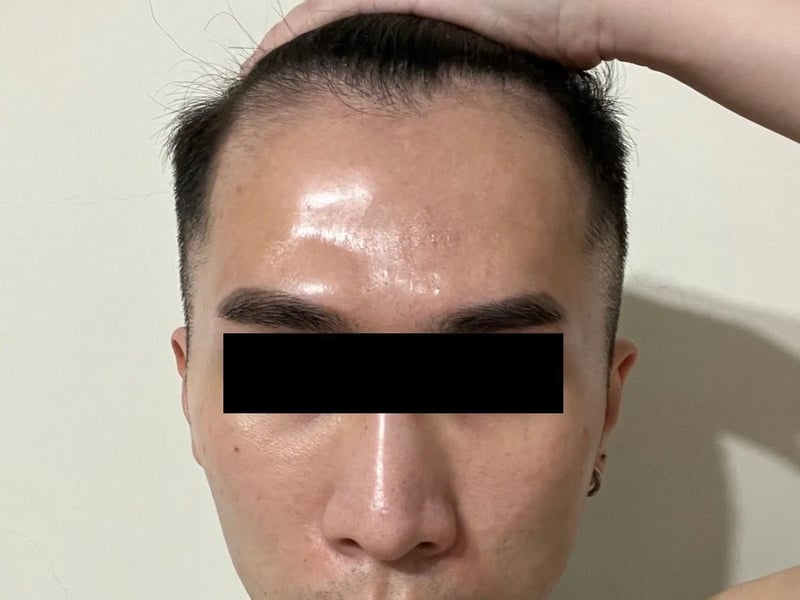 植发案例｜双侧额角 — 正面发际线：术后约 12 个月