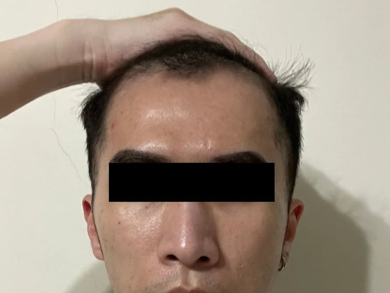 植发案例｜双侧额角 — 正面发际线：术后约 6 个月