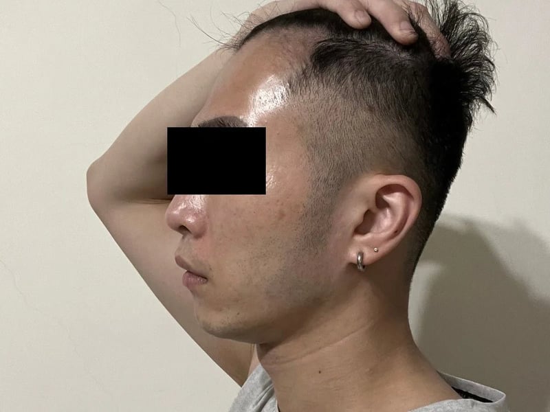 植发案例｜双侧额角 — 左侧额角：术后约 12 个月