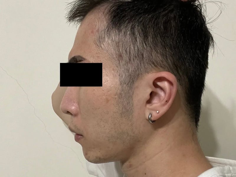 植发案例｜双侧额角 — 左侧额角：术后约 6 个月
