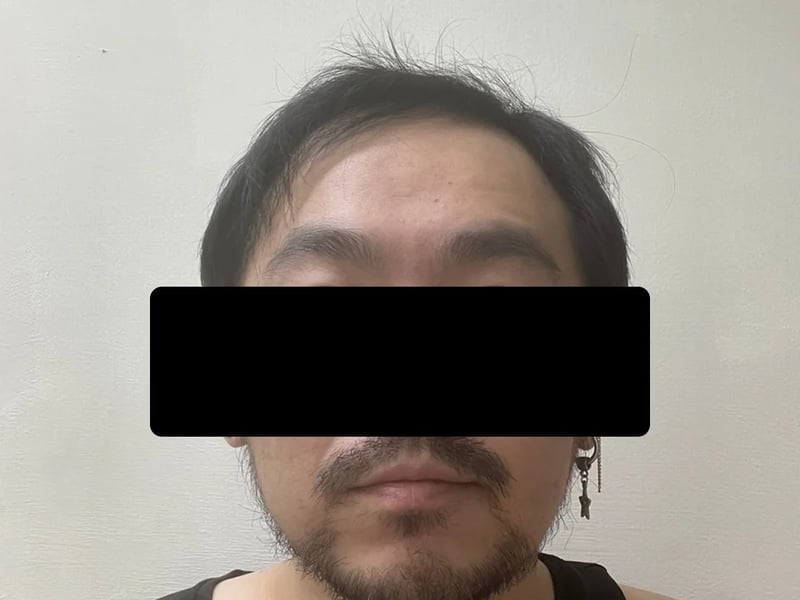 植毛症例｜前頭部の生え際 — 正面の生え際：術後約10か月