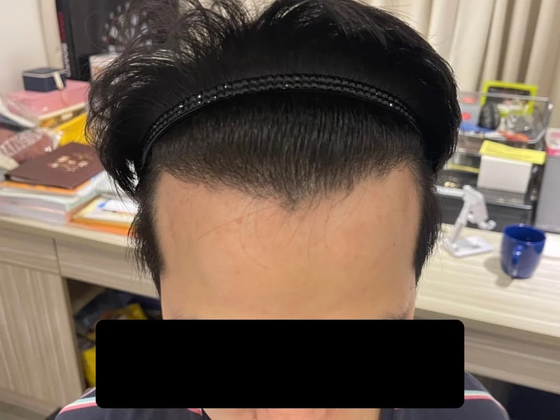 植毛症例｜前頭部の生え際 — 生え際（上から）：術後約13か月