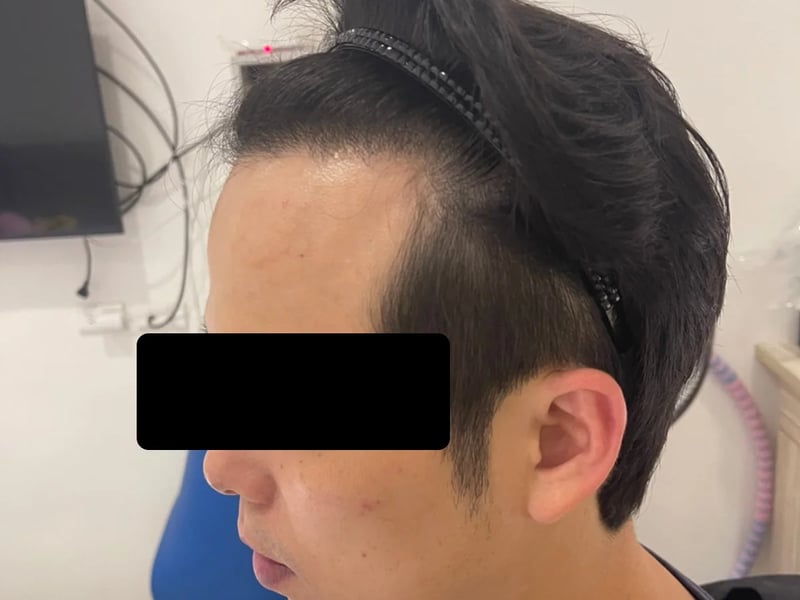 植毛症例｜前頭部の生え際 — 左こめかみ：術後約13か月