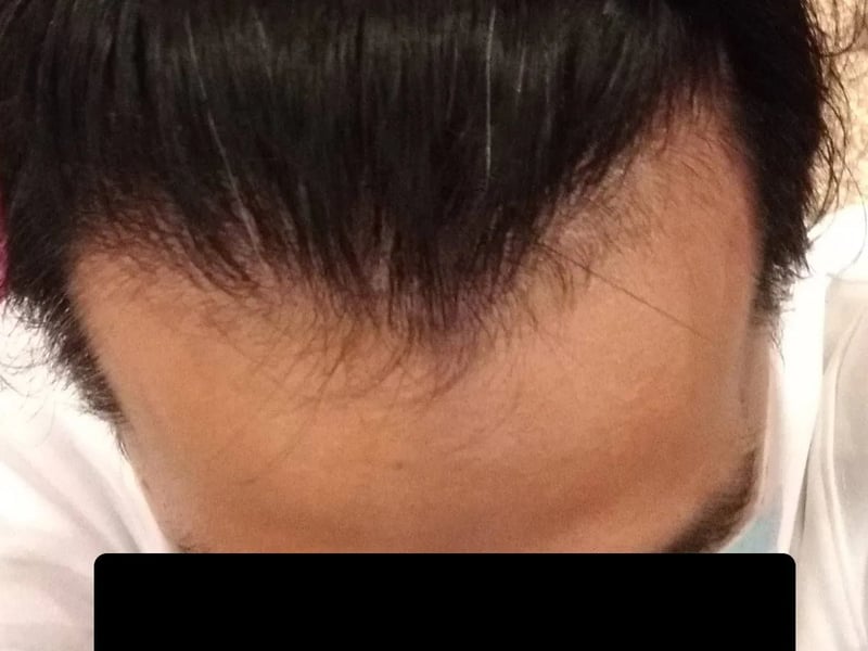 Hair transplant case｜Frontal hairline — Forehead from above：~12 months post-op