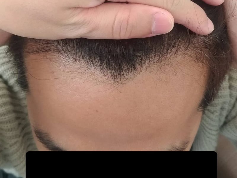 Hair transplant case｜Frontal hairline — Forehead from above：~8 months post-op