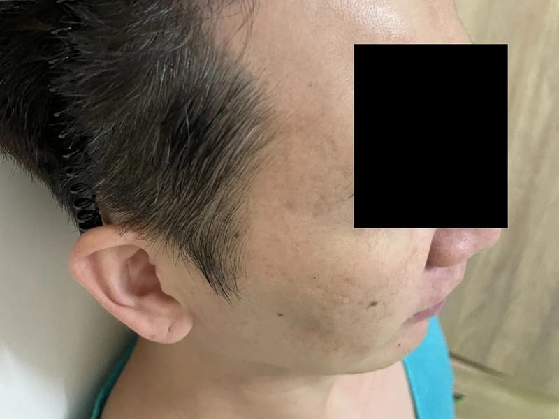植发案例｜发际线与额角 — 右侧额角：术后约 12 个月