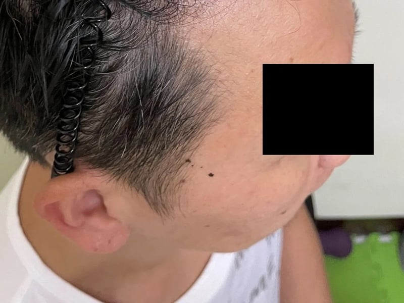 植发案例｜发际线与额角 — 右侧额角：术后约 6 个月