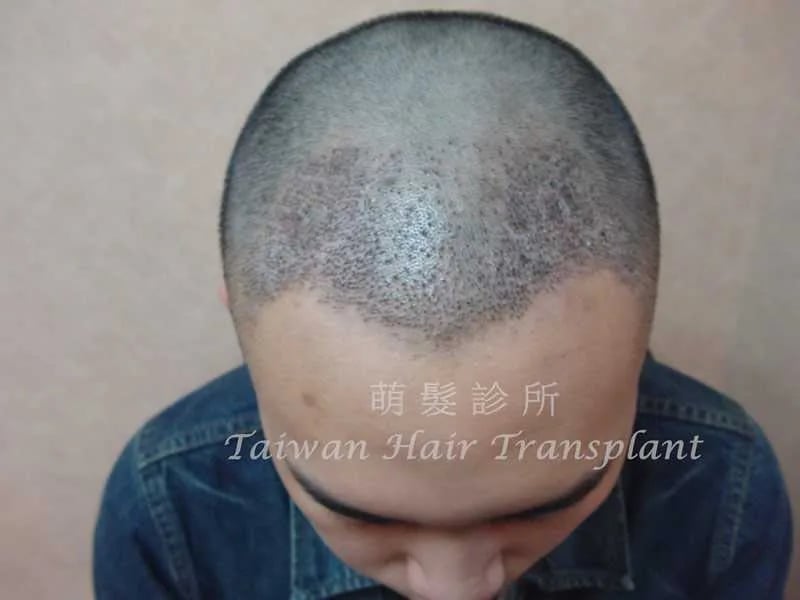 FUT 植髮術後一星期外觀紀錄，屬單一案例