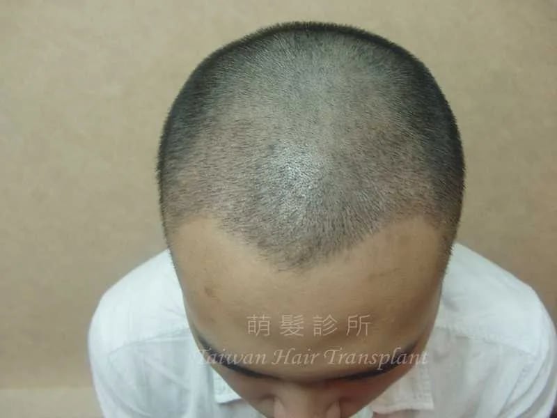 FUT 植髮術後兩星期外觀紀錄，屬單一案例