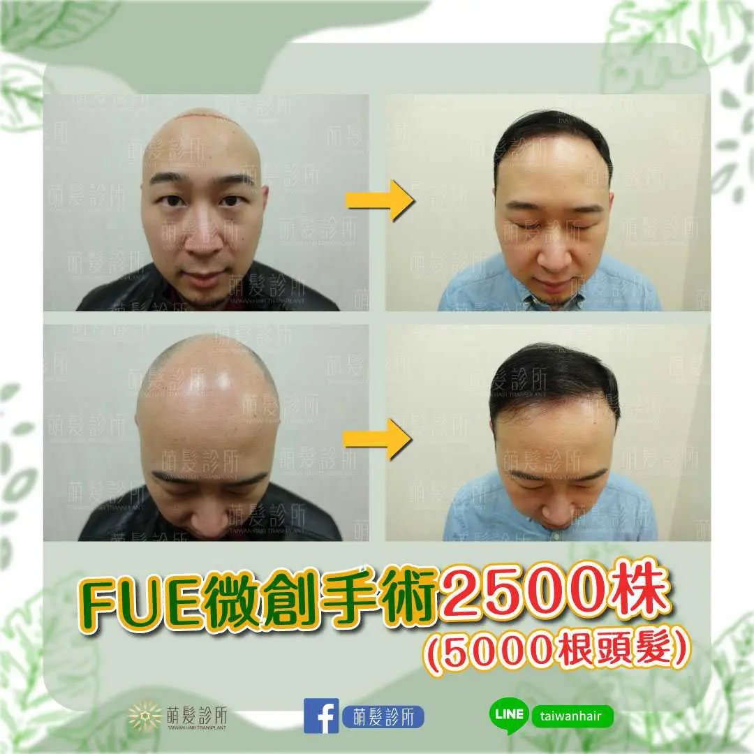 A graft is a follicular unit (may hold 1–4 hairs); grafts are roughly area × density, but still adjusted for donor supply and native hair