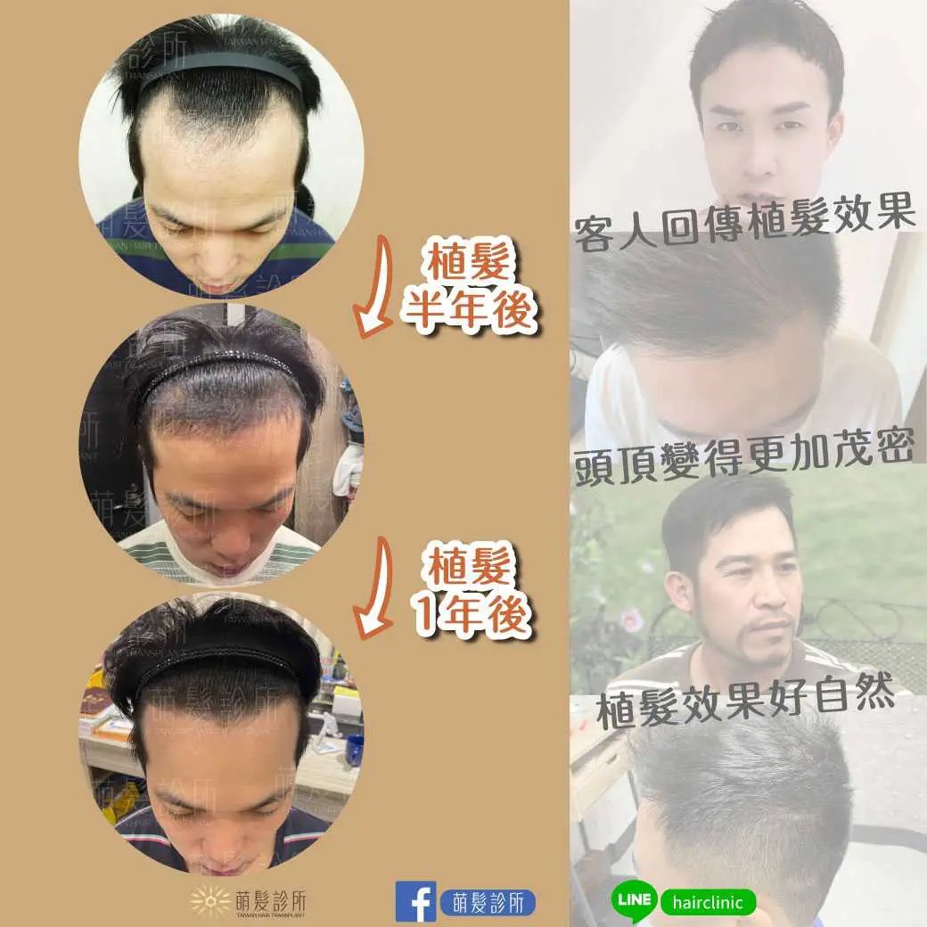 植发效果按时间轴慢慢出现：脱发期→新生发→初步效果→发质变粗→满一年定型