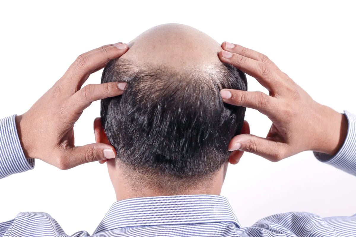 Donor condition matters more than age — whether the back of the scalp has enough good-quality follicles is the core question