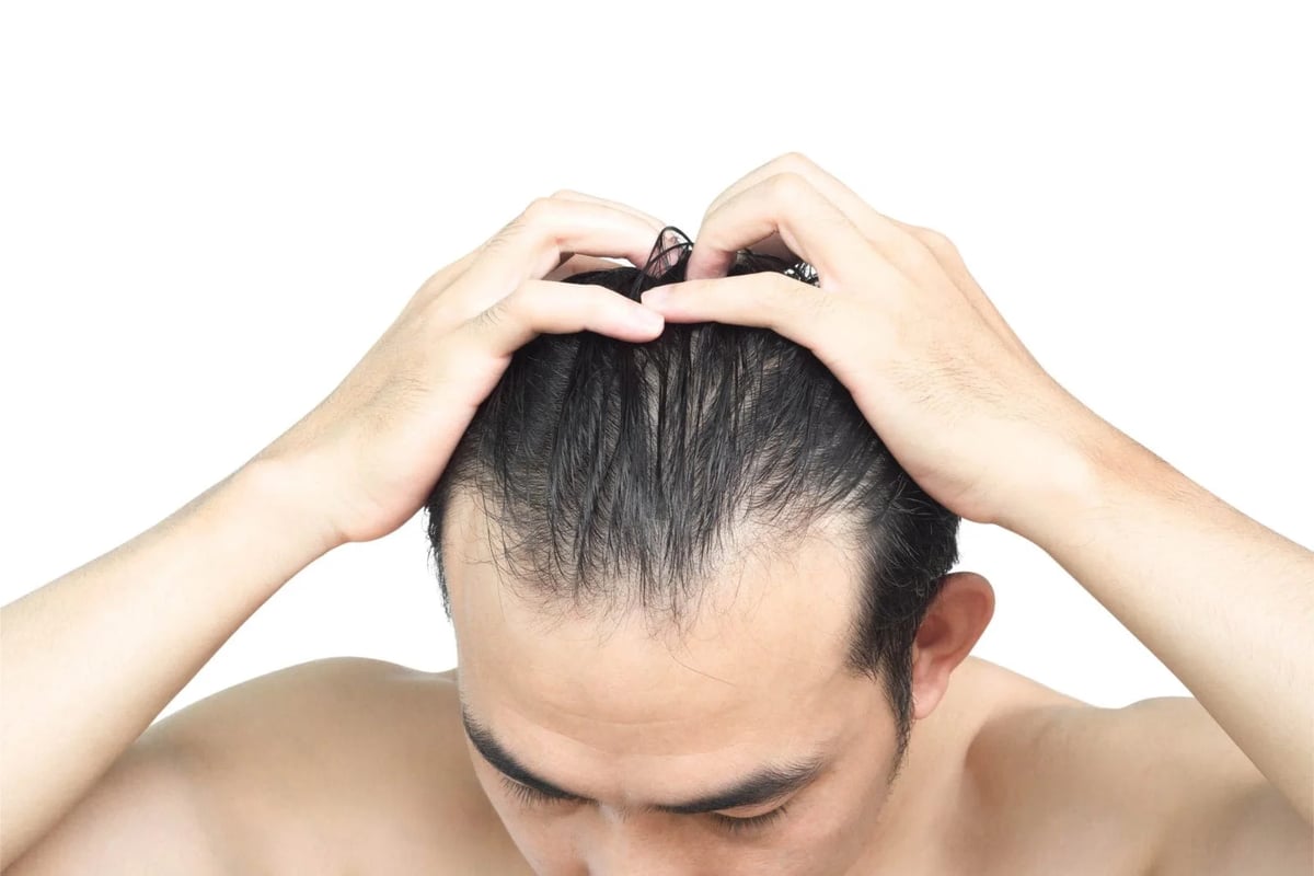 武士剃髮與現代 M 型雄性禿的原因完全不同