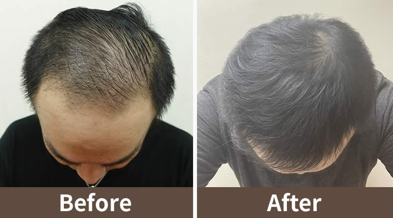 台湾萌发植发诊所-FUE微创植发,M型秃植发