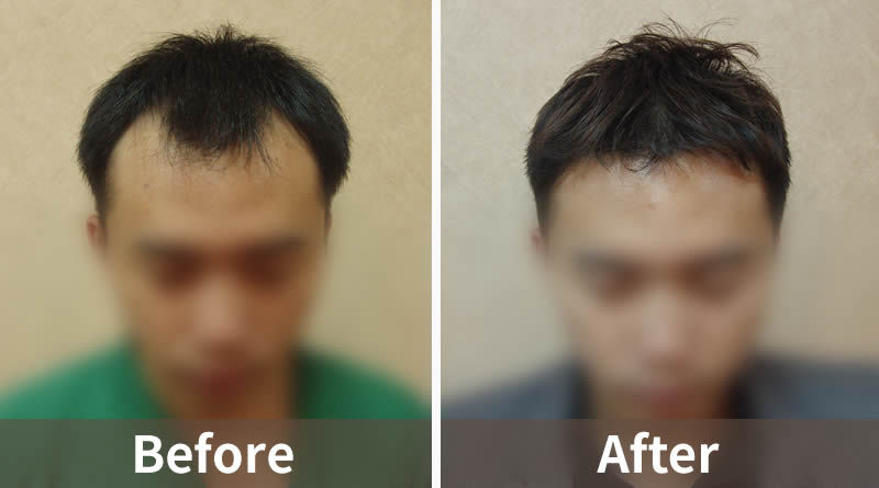 Taiwan Hair Transplant Clinic - Asian FUE&FUT hair transplant