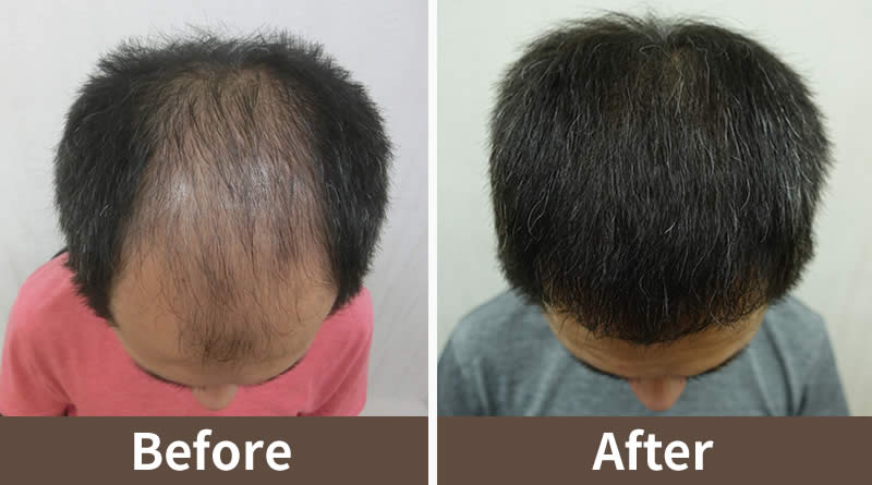 台湾萌发植发诊所-FUE微创植发,M型秃植发